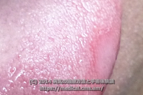 舌側面の舌炎