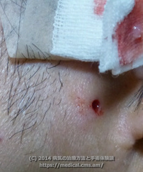 耳ともみあげの間の粉瘤（アテローム）摘出手術　手術後