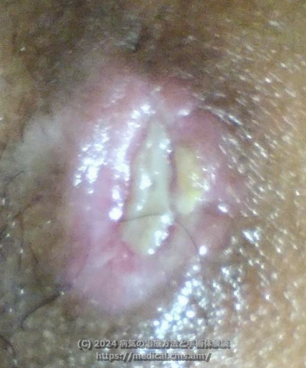 膿皮症切除手術1ヶ月後
